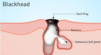 12 cách loại bỏ mụn đầu đen hiệu quả