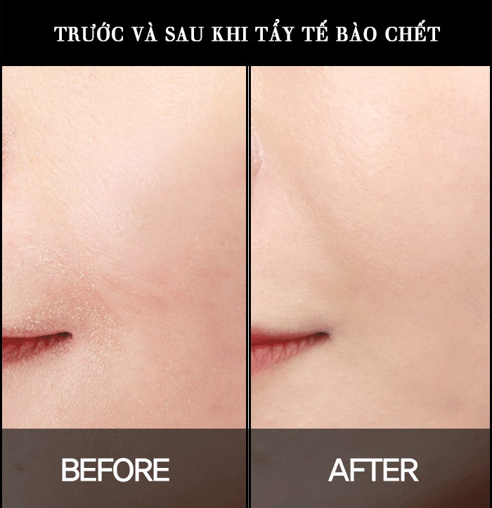 12 cách loại bỏ mụn đầu đen hiệu quả
