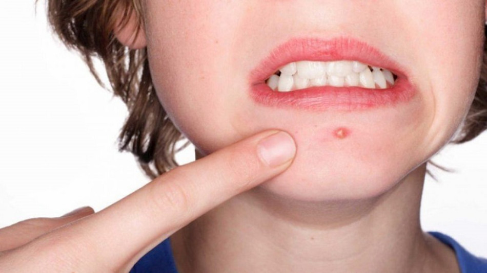 13 Cách Chăm Sóc Da Mặt Để Không Bị Mụn Hiệu Quả