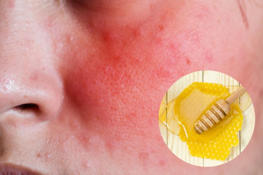 13 Cách Dùng Mật Ong Để Làm Đẹp Da Trị Mụn Cực Kỳ Hiệu Quả