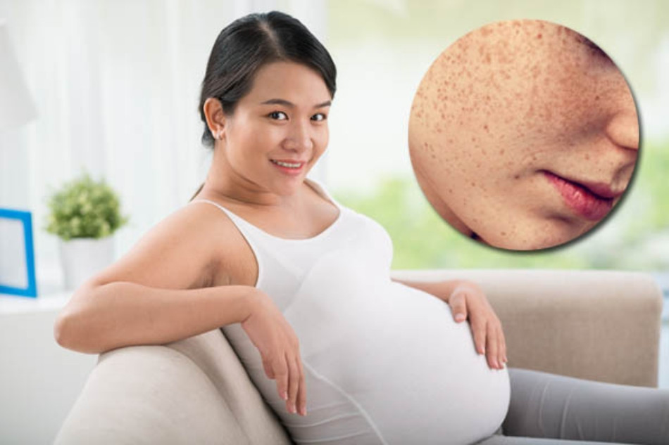 13 Cách Trị Nám Da Dành Cho Bà Bầu An Toàn Và Hiệu Quả