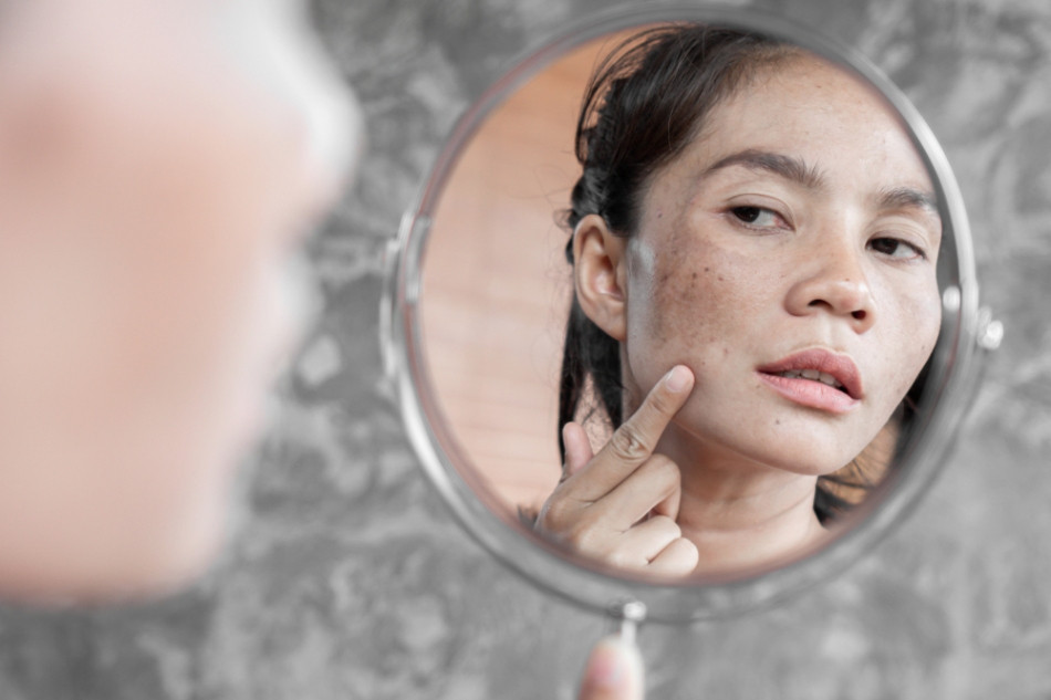 13 Cách Trị Nám Da Dành Cho Bà Bầu An Toàn Và Hiệu Quả