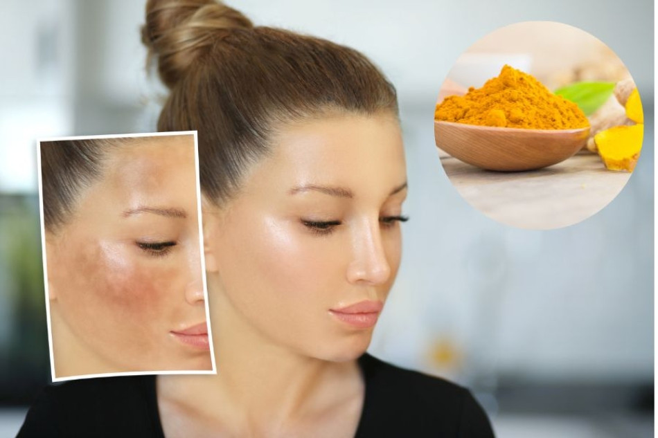 13 Cách Trị Nám Da Dành Cho Bà Bầu An Toàn Và Hiệu Quả