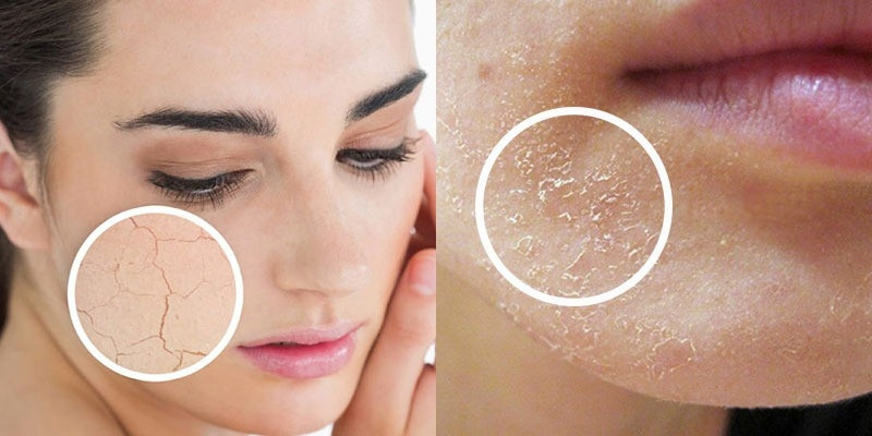 14 Cách Dưỡng Ẩm Cho Da Mặt Bị Khô Để Làn Da Luôn Mềm Mại