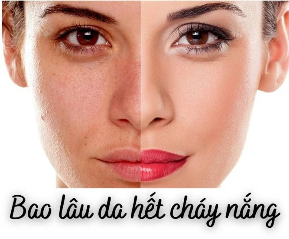 15 Cách Chăm Sóc Da Bị Cháy Nắng Hiệu Quả