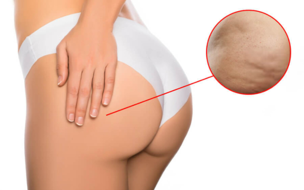 15 Cách Chăm Sóc Da Vùng Mông Trắng, Mịn Hiệu Quả