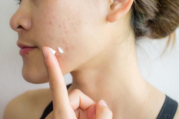 5 nguyên nhân bị dị ứng kem chống nắng và giải pháp khắc phục