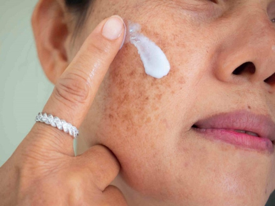 8 nguyên nhân gây nám tàn nhang và cách phòng ngừa hiệu quả