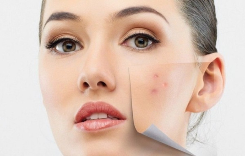 Cách Chăm Sóc Da Dầu Mụn Hiệu Quả: 8 Bước Đơn Giản Giúp Phục Hồi Nhanh Chóng