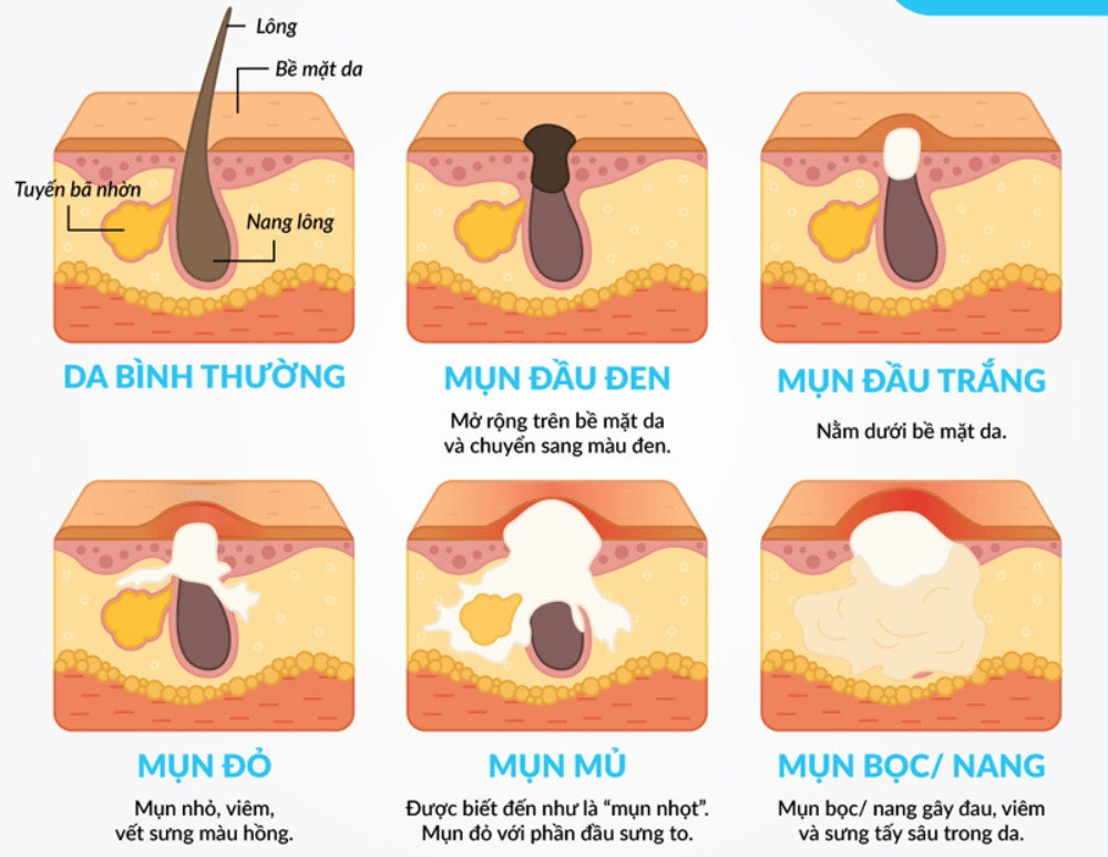 Cách chăm sóc da lưng bị mụn hiệu quả và ngăn ngừa tái phát
