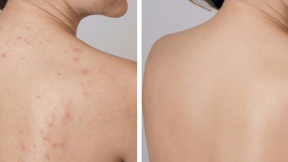 Cách chăm sóc da lưng bị mụn hiệu quả và ngăn ngừa tái phát