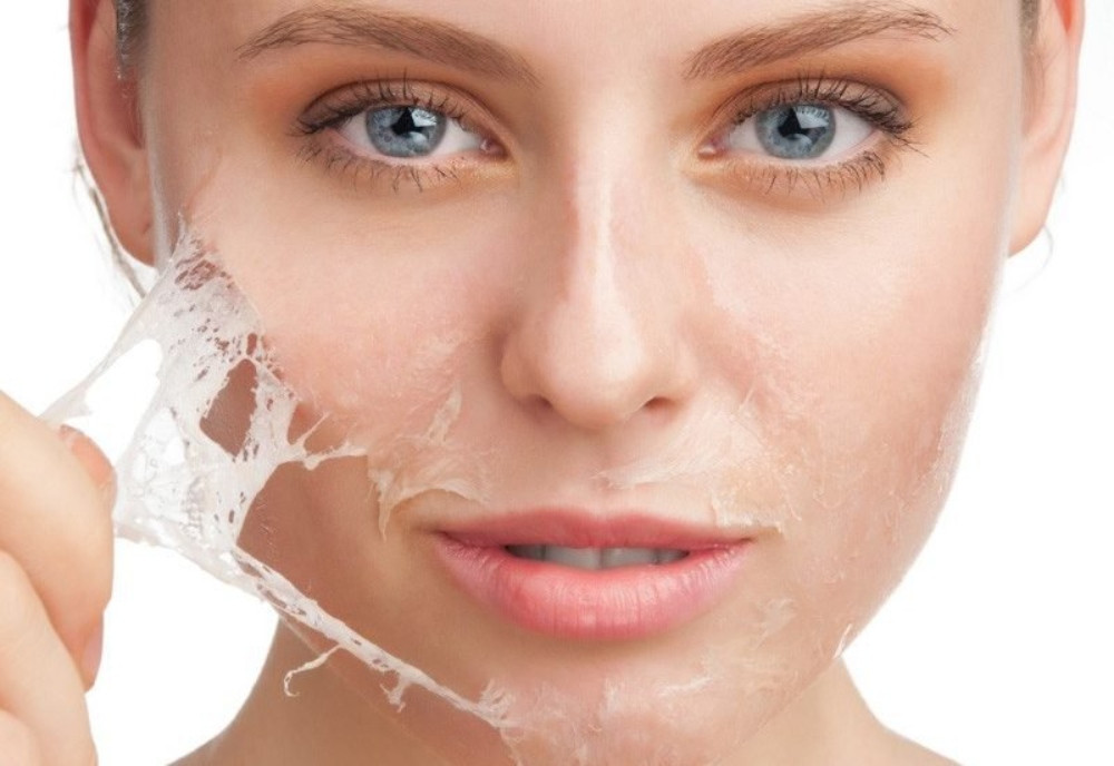 Cách chăm sóc da mặt bị mụn ẩn đơn giản, hiệu quả tại nhà 