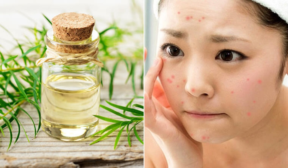 Cách chăm sóc da mặt bị mụn ẩn đơn giản, hiệu quả tại nhà 