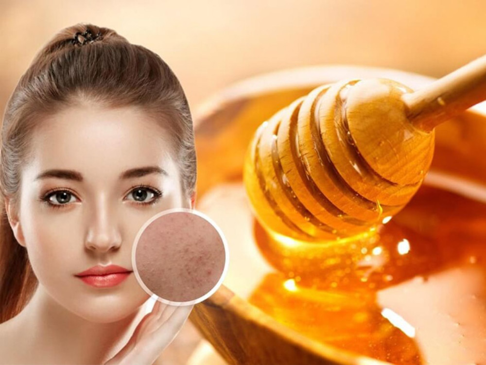 Cách chăm sóc da mặt bị mụn ẩn đơn giản, hiệu quả tại nhà 