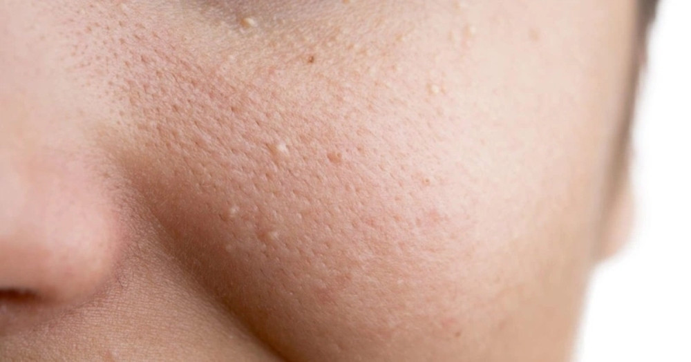 Cách chăm sóc da mặt bị mụn ẩn đơn giản, hiệu quả tại nhà 