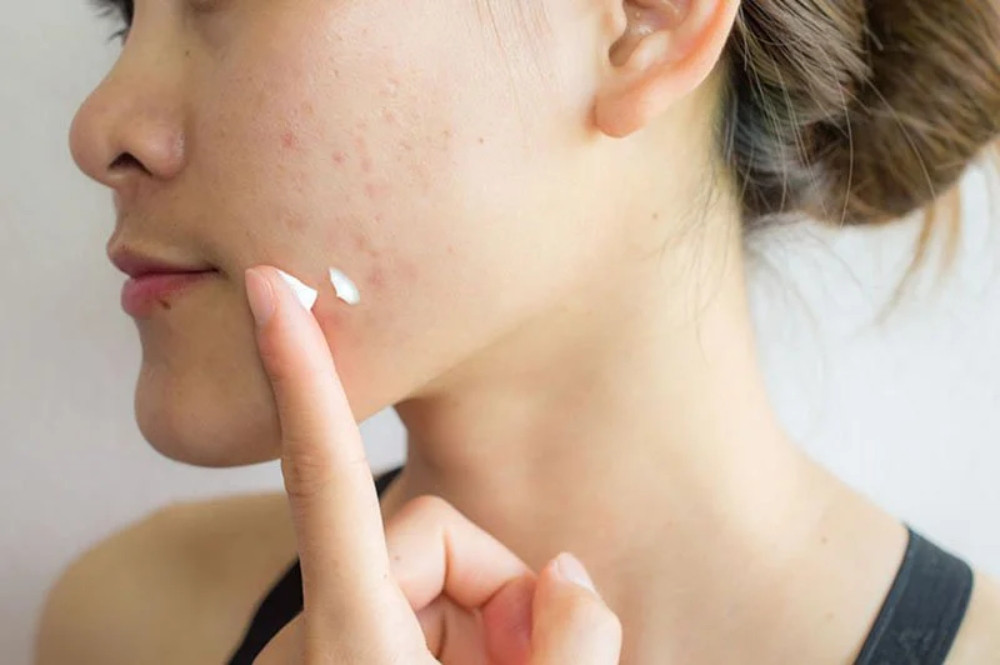 Cách chăm sóc da mặt bị mụn ẩn đơn giản, hiệu quả tại nhà 