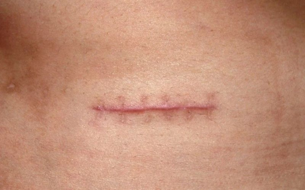 Cách chăm sóc vết thương không để lại sẹo mà bạn cần biết
