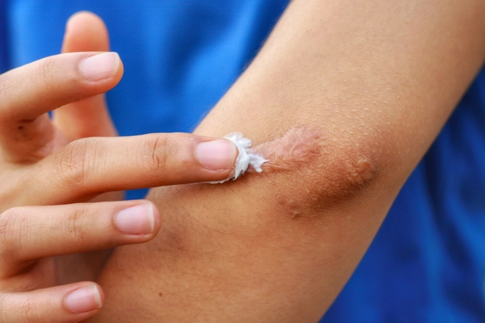 Cách chăm sóc vết thương không để lại sẹo mà bạn cần biết