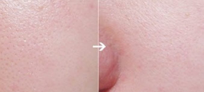 Cách Se Khít Lỗ Chân Lông Hiệu Quả