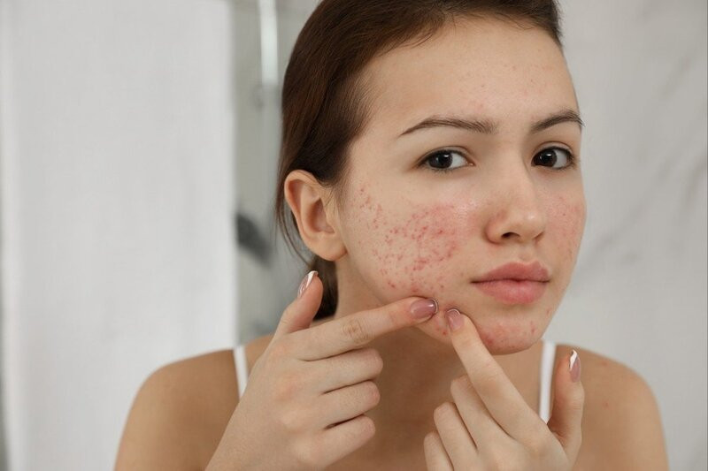 Chăm sóc da nhạy cảm: Lời khuyên và bí quyết hiệu quả bạn không thể bỏ qua