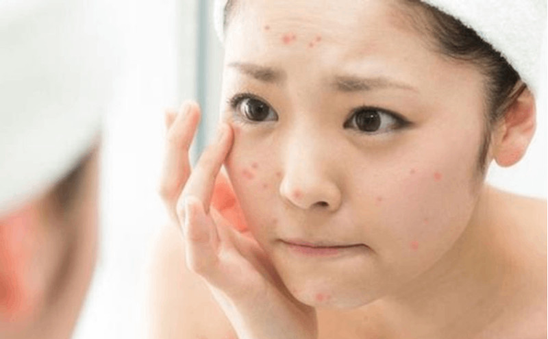 Chăm sóc da nhạy cảm: Lời khuyên và bí quyết hiệu quả bạn không thể bỏ qua