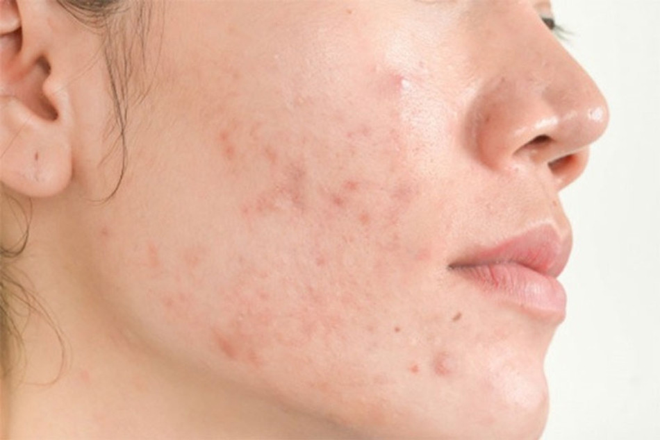 Da Dầu Mụn: Hướng Dẫn Chăm Sóc Đặc Biệt Để Kiểm Soát Dầu Thừa và Ngăn Chặn Mụn Phát Triển