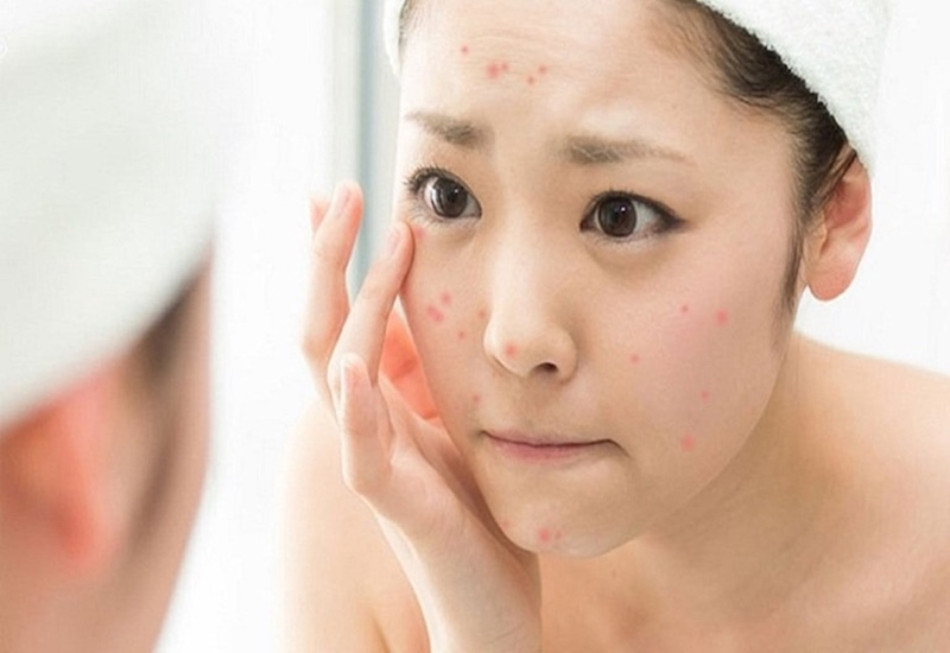 Da Dầu Mụn: Hướng Dẫn Chăm Sóc Đặc Biệt Để Kiểm Soát Dầu Thừa và Ngăn Chặn Mụn Phát Triển