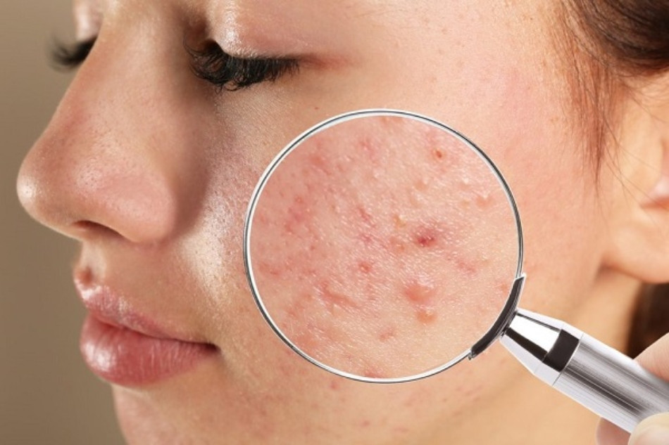 Da Dầu Mụn: Hướng Dẫn Chăm Sóc Đặc Biệt Để Kiểm Soát Dầu Thừa và Ngăn Chặn Mụn Phát Triển