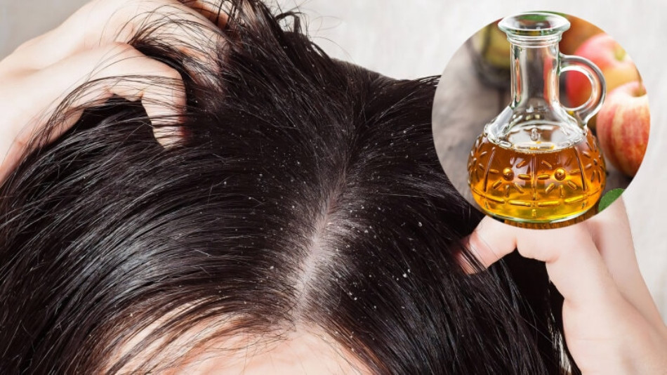 Gàu ống có lây không? 9 nguyên nhân thực sự gây ra gàu ống