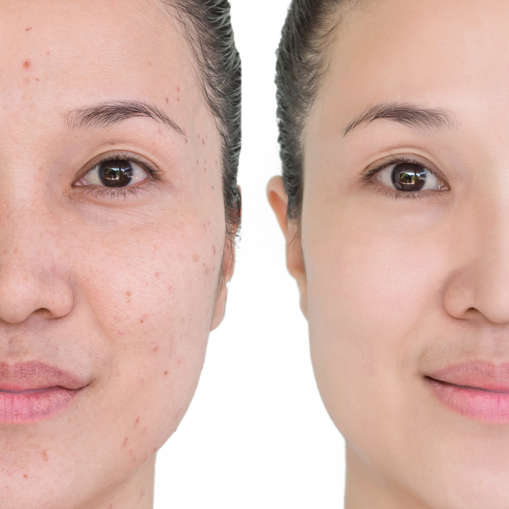 Hiểu về sẹo: Nguyên nhân, loại sẹo và cách điều trị hiệu quả