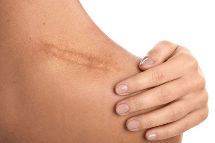 Hiểu về sẹo: Nguyên nhân, loại sẹo và cách điều trị hiệu quả