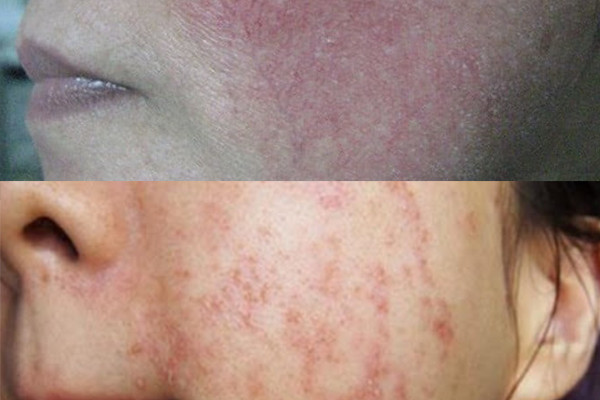 Kem trộn là gì? 3 dấu hiệu nhận biết da bị nhiễm độc Corticoid