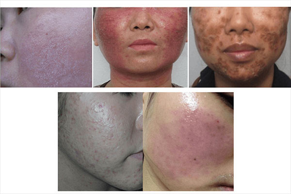 Kem trộn là gì? 3 dấu hiệu nhận biết da bị nhiễm độc Corticoid