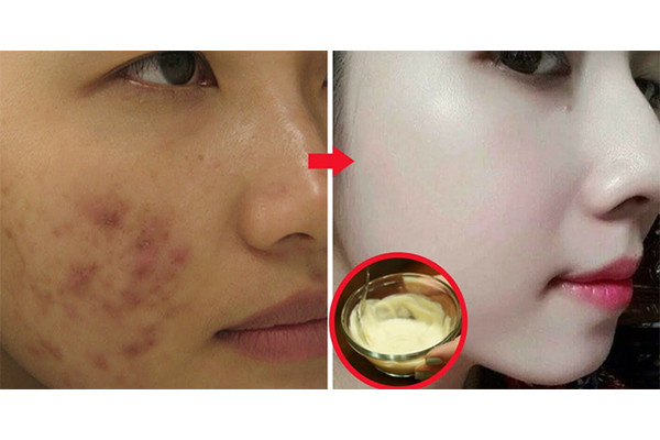 Kem trộn là gì? 3 dấu hiệu nhận biết da bị nhiễm độc Corticoid