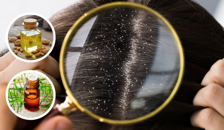 Mẹo 15 cách trị hết gàu TẬN GỐC cực nhanh và đơn giản tại nhà