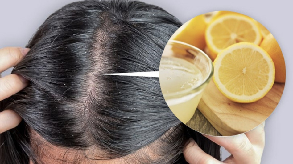 Mẹo 15 cách trị hết gàu TẬN GỐC cực nhanh và đơn giản tại nhà