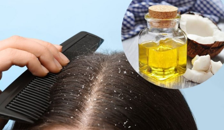 Mẹo 15 cách trị hết gàu TẬN GỐC cực nhanh và đơn giản tại nhà