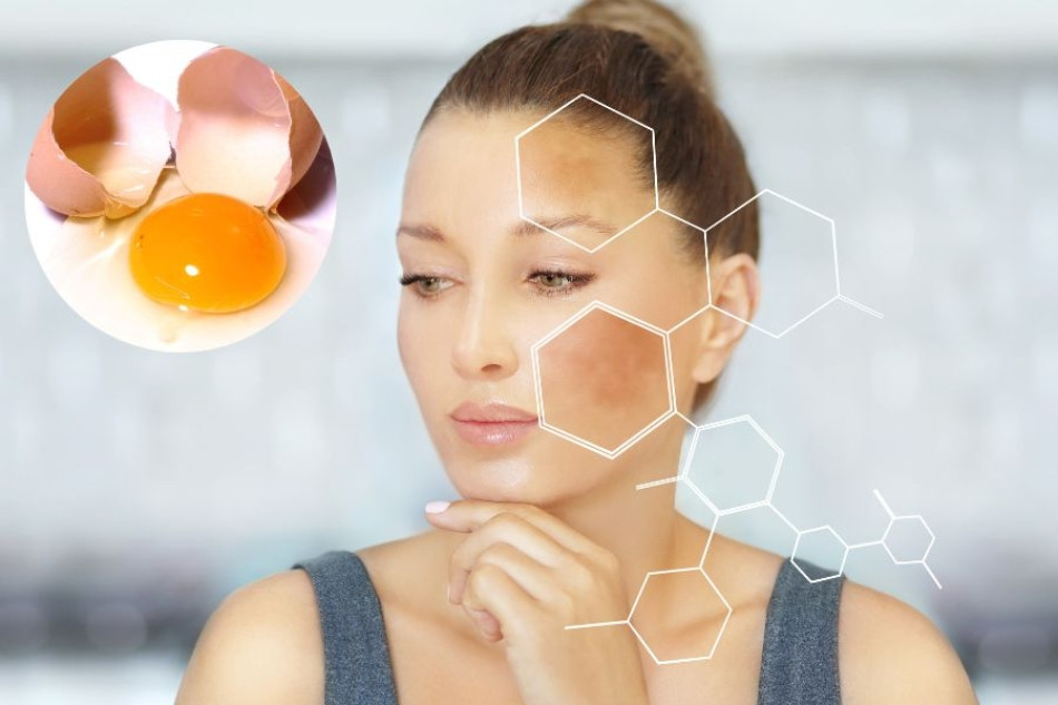 Mẹo 17+ cách trị nám da mặt bằng thiên nhiên đơn giản tại nhà