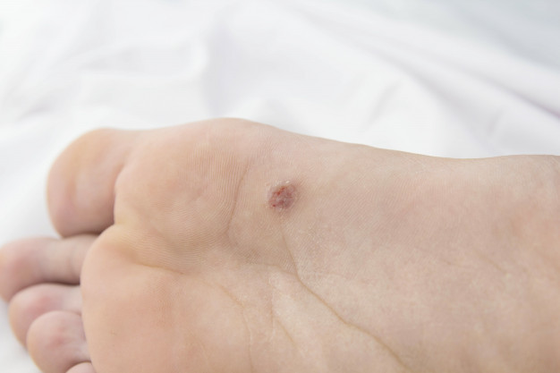 Mụn cóc là gì? 6 cách trị mụn cóc hiệu quả