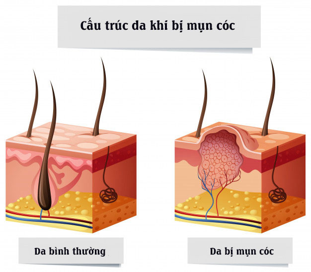 Mụn cóc là gì? 6 cách trị mụn cóc hiệu quả