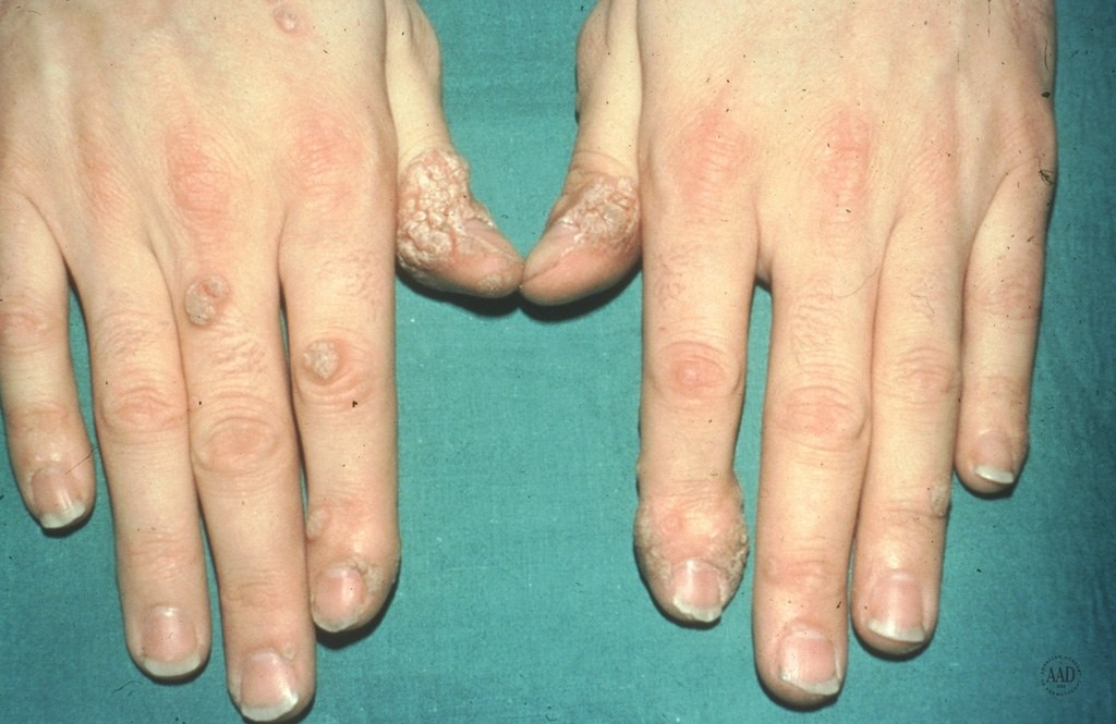 Mụn cóc là gì? 6 cách trị mụn cóc hiệu quả