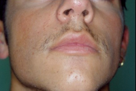 Mụn cóc là gì? 6 cách trị mụn cóc hiệu quả