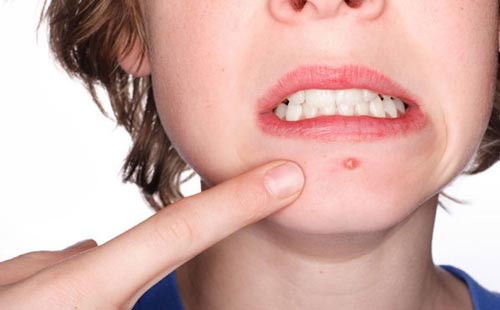Mụn trứng cá: Nguyên nhân, cách nhận biết và giải pháp hiệu quả
