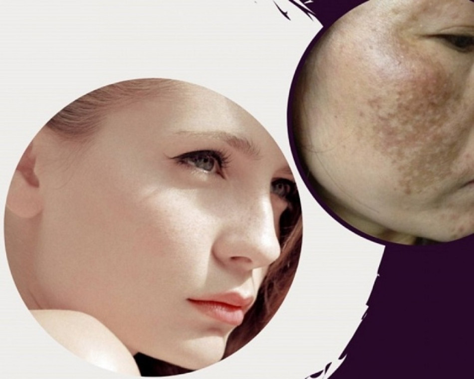 Nám chân đinh có chữa được không? Cách điều trị hiệu quả