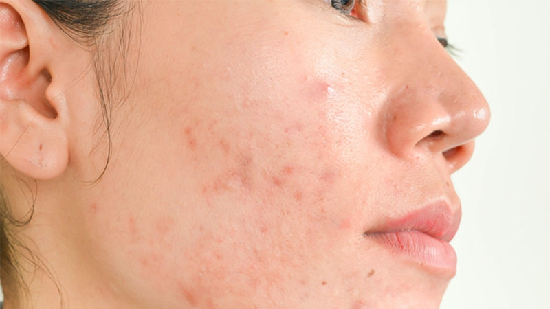 Nguyên nhân và 12+ cách hạn chế da tiết dầu hiệu quả