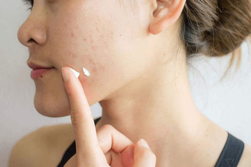 Quy Trình 7 Bước Chăm Sóc Da Cho Da Khô Mụn Hiệu Quả