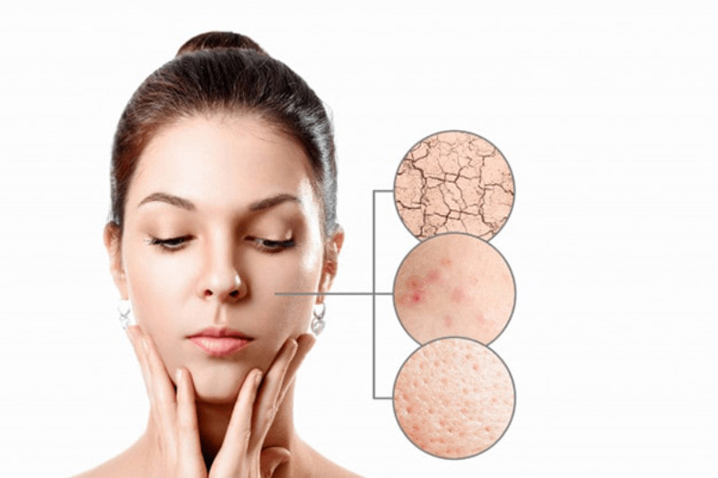 Quy Trình 7 Bước Chăm Sóc Da Cho Da Khô Mụn Hiệu Quả