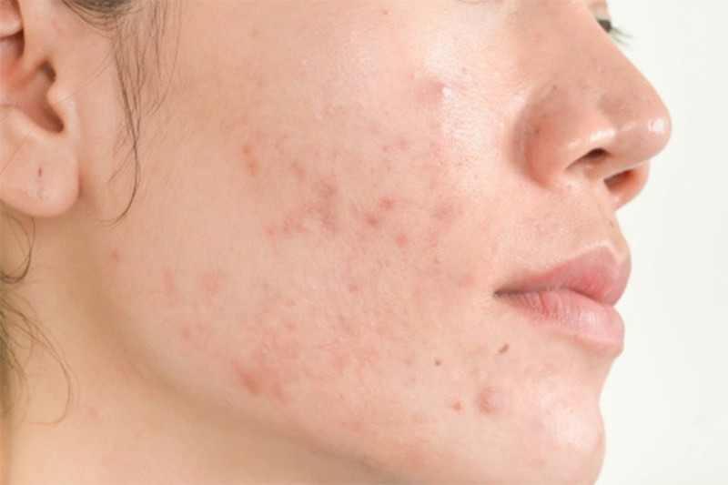 Quy trình chăm sóc da tối giản: Giải pháp cho làn da khỏe mạnh