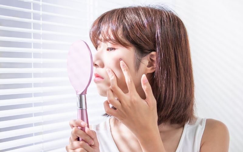 Vì sao dùng kem chống nắng bị mụn? Nguyên nhân và Giải pháp